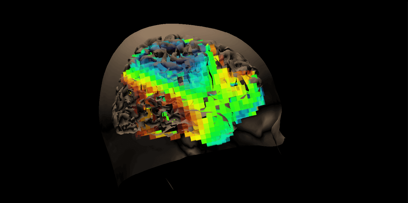 concussion brain scan